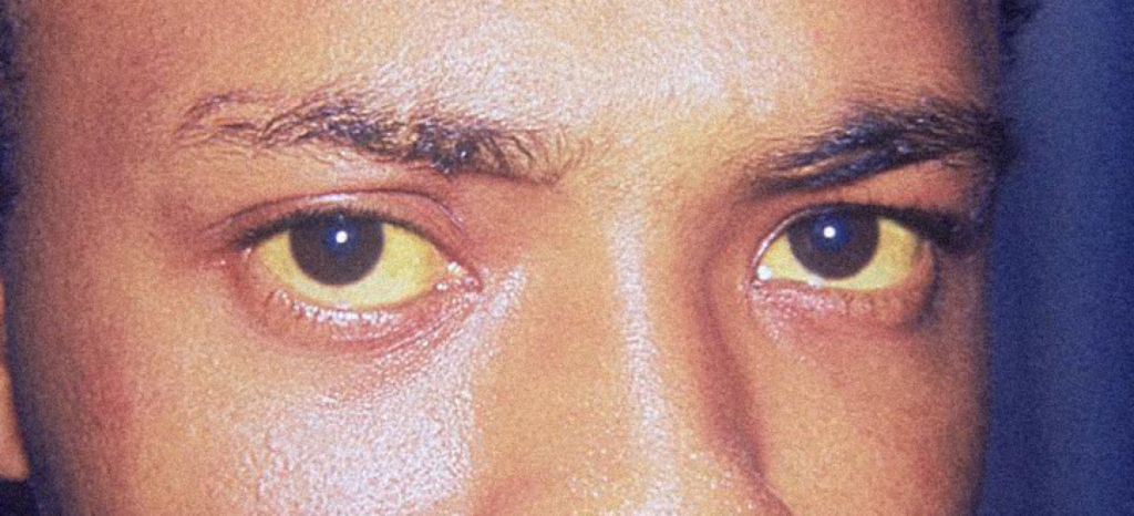 желтые белки глаз человека