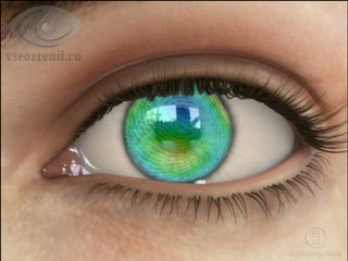 SuperLASIK при дальнозоркости