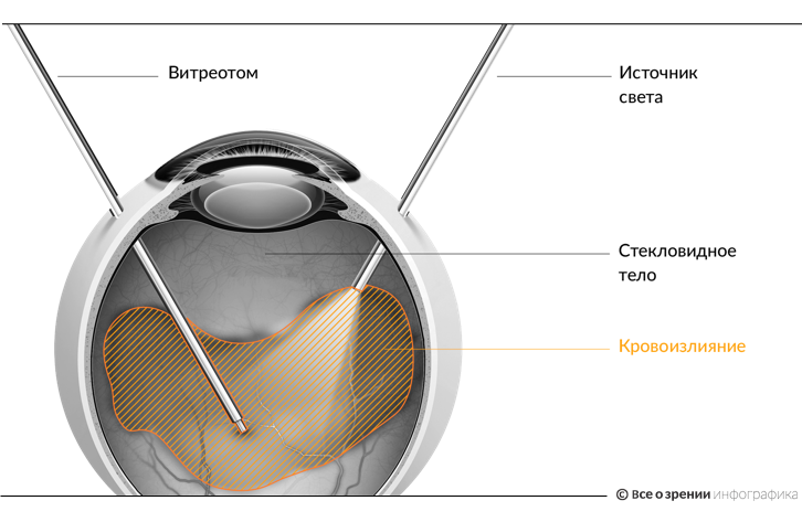 Витреотом. Витреолизис стекловидного тела. Лазерный витреолизис. Стекловидное тело операция