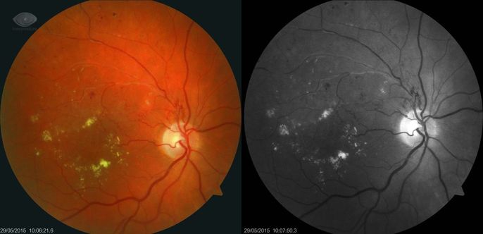 posttromboticheskaya-retinopatiya.jpg