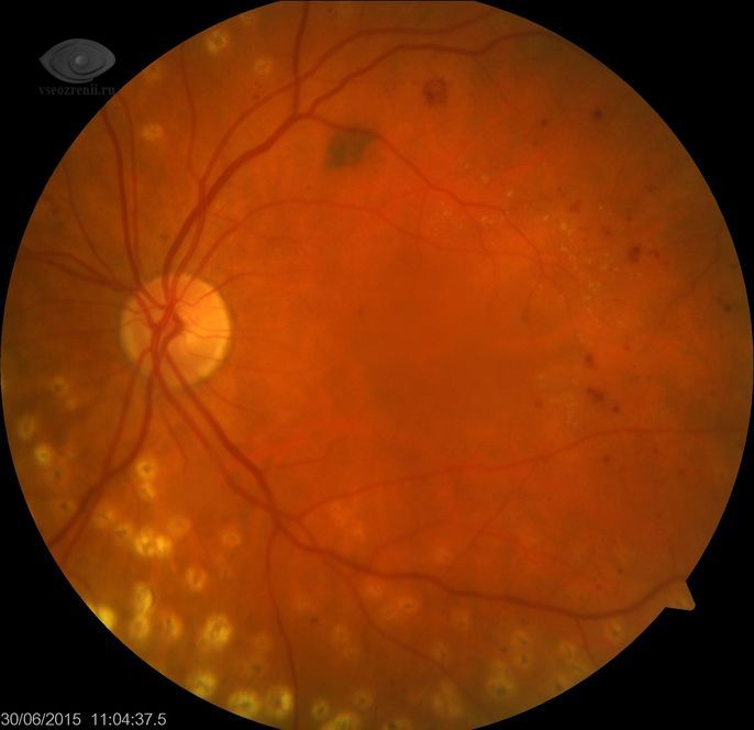 diabeticheskaya-retinopatiya2.jpg