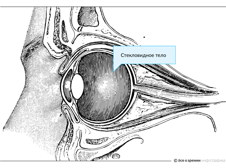 стекловидное тело деструкция