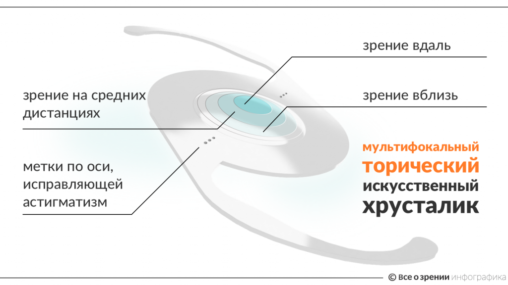 ustrojstvo-multifokalnoj-toricheskoj-iol.png