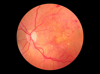 Анти-VEGF (ВиДжиЭф) терапия — только она может спасти зрение при влажной ВМД