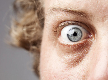 Осложнения после уколов в стекловидное тело глаза (интравитреальные инъекции)