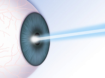 Лазерная коагуляция сетчатки — дополнительное лечение ретинопатии и ДМО при диабете